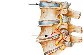 malusog na disc at nasira na disc na may lumbar osteochondrosis