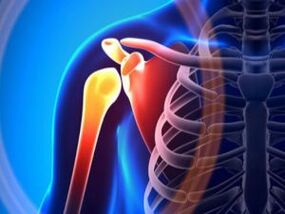 Inflamed shoulder joint dahil sa arthrosis - isang malalang sakit ng musculoskeletal system