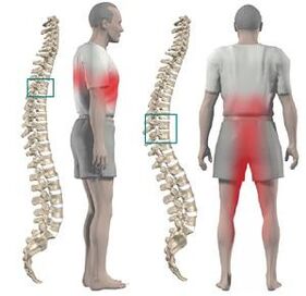 Ang sakit na may thoracic chondrosis ay maaaring ibigay sa mas mababang mga paa at crotch