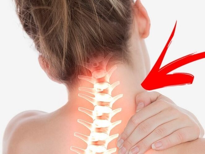 Ang compression ng mga ugat ng nerbiyos na may cervical osteochondrosis