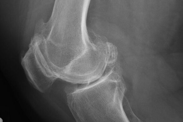 Mga pamamaraan para sa pag -diagnose ng arthrosis ng tuhod