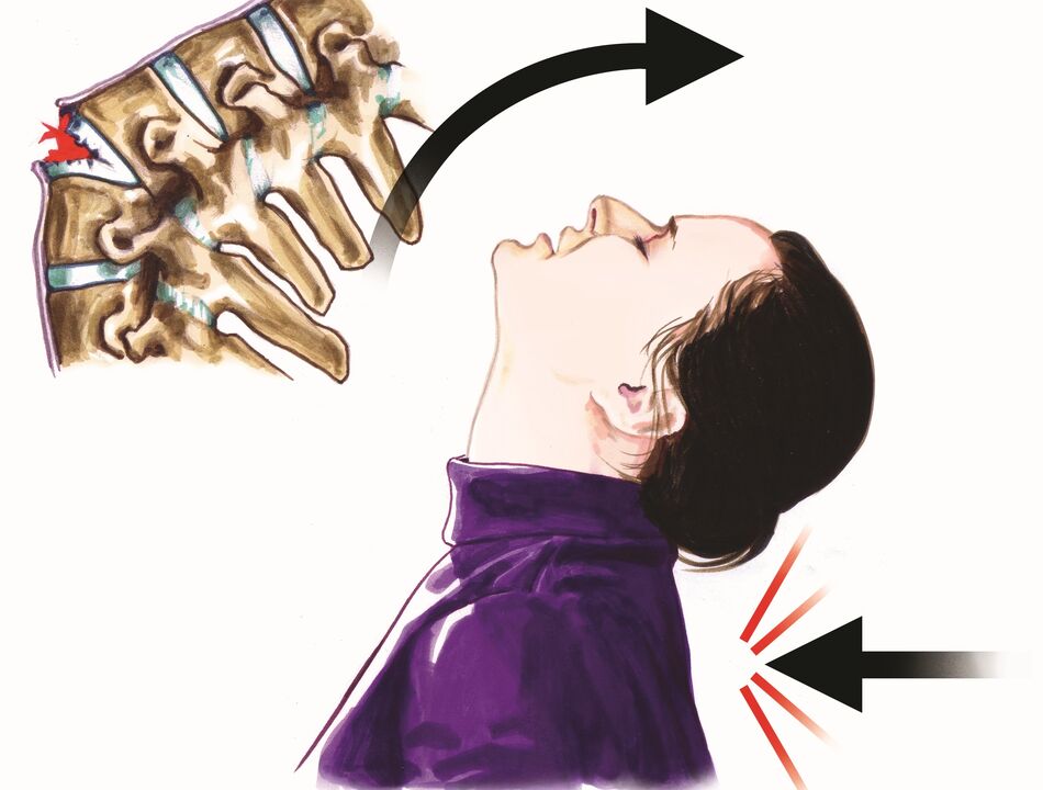 pinsala sa gulugod bilang sanhi ng pananakit ng leeg