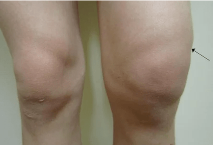 Hemarthrosis ng kasukasuan ng tuhod